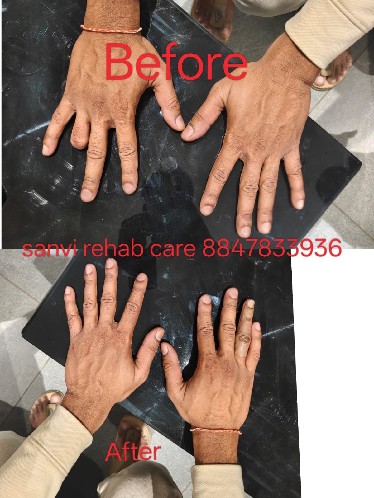 Prosthesis Silicon Finger